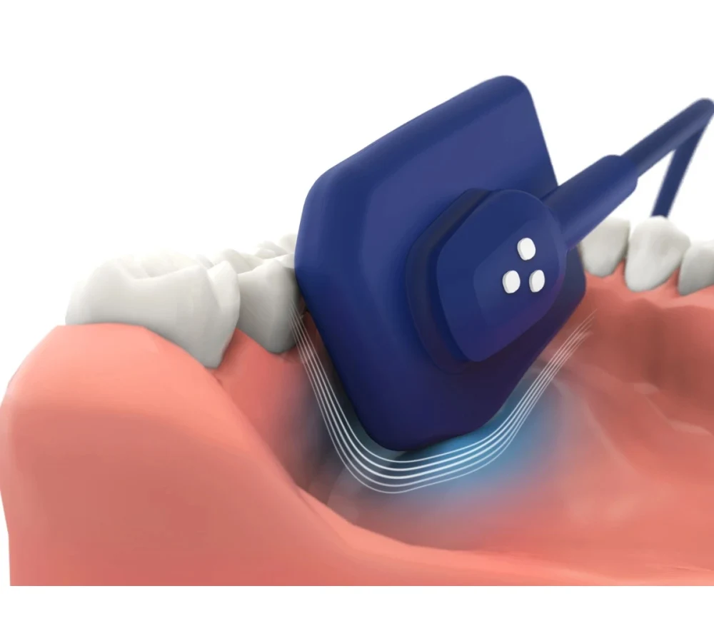 Vatech EzSensor Soft цифровой интраоральный радиовизиограф 1.5